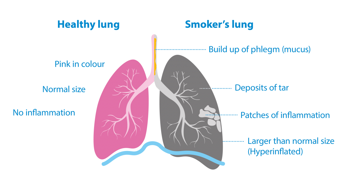 Why Is Smoking Bad For You? The Effects Of Smoking | Asthma + Lung UK